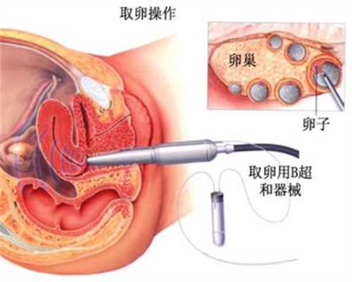 北京代孕咨询,免疫性不孕会排卵吗
